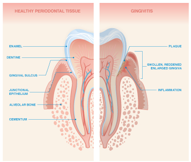 Gingivitis Vs Periodontitis