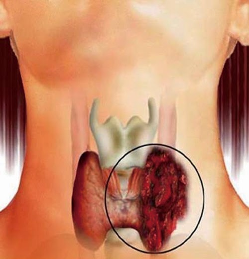 Cara untuk Mengobati Kanker Tiorid Cara untuk Mengobati Kanker Tiorid