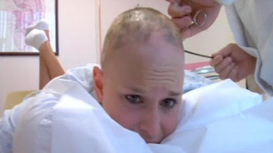 Georgia Van Cuylenburg - Alopecia areata