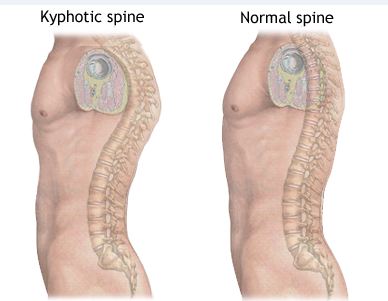 Exercise and Posture: Kyphosis