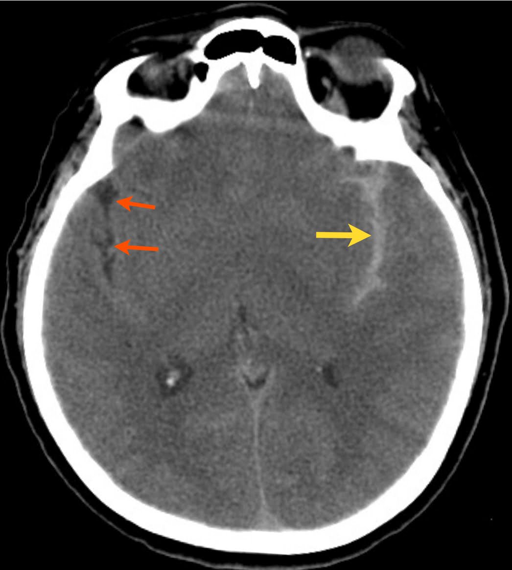 ct brain sah