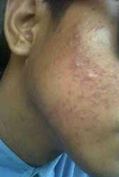 home remedies for acne home remedies for acne