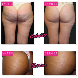 Gel Dating Para Cicatricure Herpes