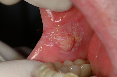 kanker mulut adalah kanker yang menyerang pada salah satu bagian ...