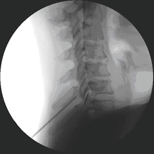 Lumbar epidural steroid injection without fluoroscopy