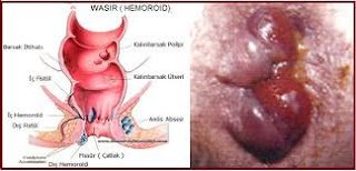 Obat Wasir Faktu Supp Obat Wasir Faktu Supp