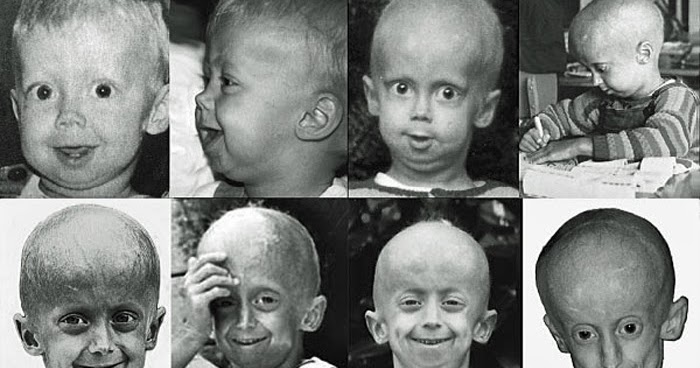 progeria family circle: symptoms