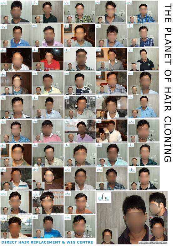 Best Hair Weaving Clinic Center In New Delhi Gurgoan Noida India