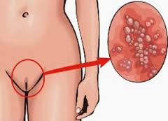 Ciri-ciri penyakit kutil kelamin (HPV) Ciri-ciri penyakit kutil kelamin (HPV)