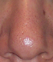 Big Nose Pores