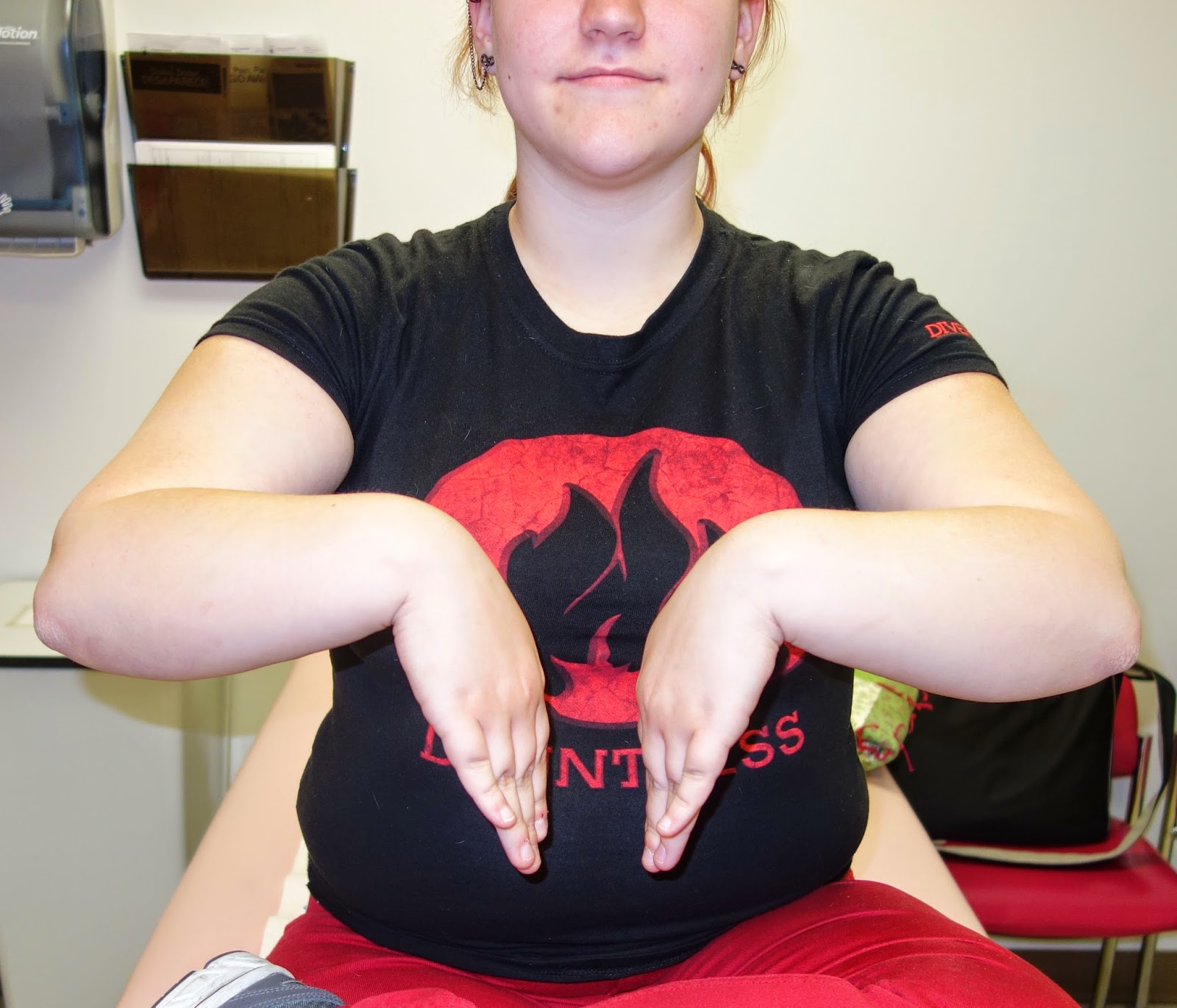 Severe Madelungs Deformity Congenital Hand and Arm Differences Washington University in St