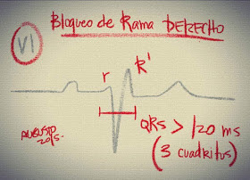 schamroth ecg pdf schamroth ecg pdf