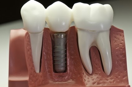 remplacement de la dent