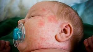 bebegim bebeklerde isilik