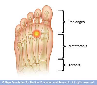 Plantar Fasciitis,Pes Planus,Mallet Toe,High Arched Feet,Heel Spur,Heel Pain,Hammer Toe,Hallux Valgus,Foot Pain,Foot Hard Skin,Foot Conditions,Foot Callous,Flat Feet,Fallen Arches,Diabetic Foot,Contracted Toe,Claw Toe,Bunions Hard Skin,Bunions Callous,Bunion Pain,Ball Of Foot Pain,Back Pain