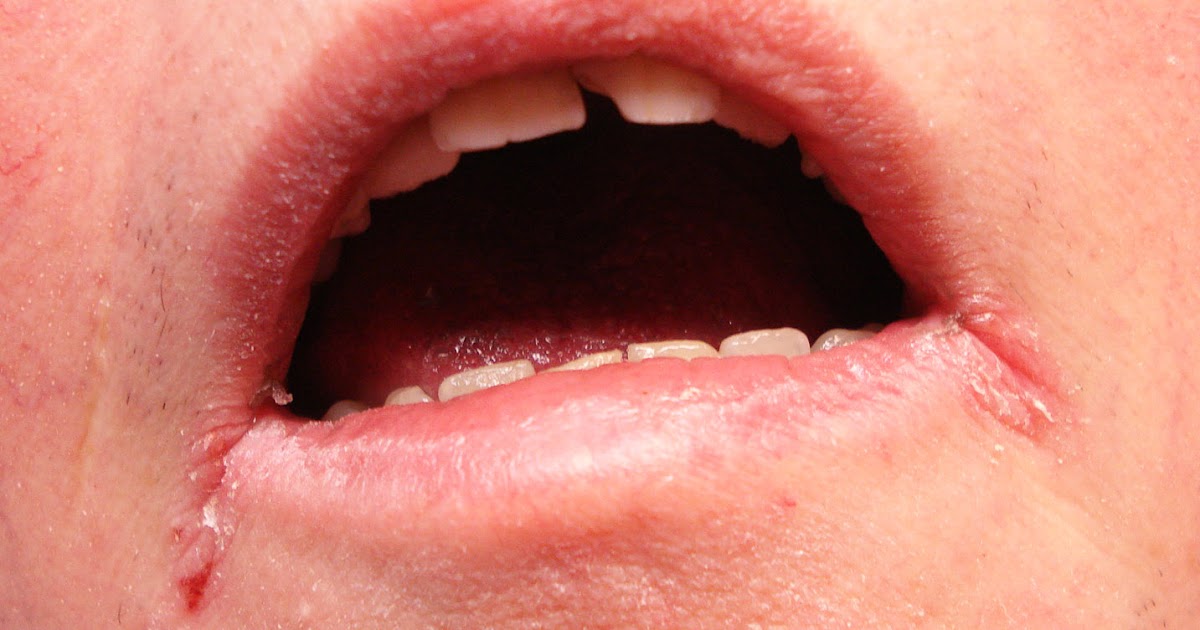 VIRTUAL GRAND ROUNDS IN DERMATOLOGY 2.0 Zinc Deficiency Syndrome?