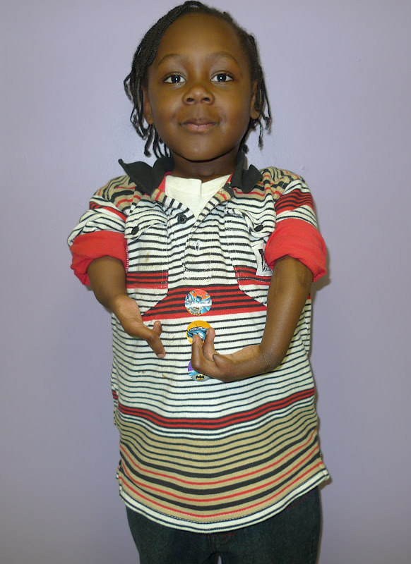 Great Function in Ulnar Deficiency Congenital Hand and Arm