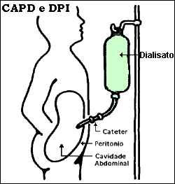 Dialise Peritoneal CAPD.