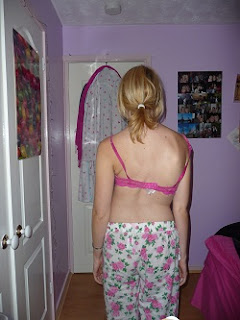 My scoliosis before scoliosis surgery