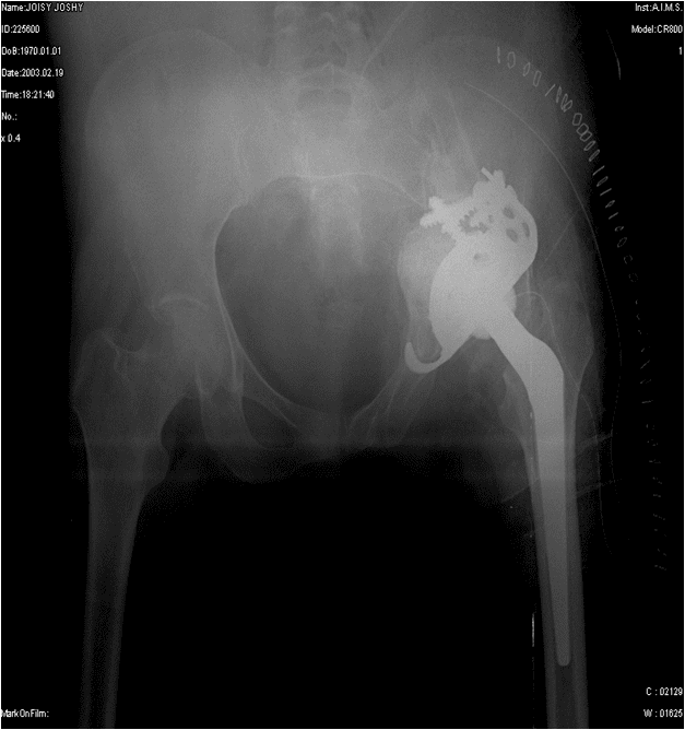 Hip pain while 37 weeks pregnant video, herniated disc l4 l5 hip pain x ray