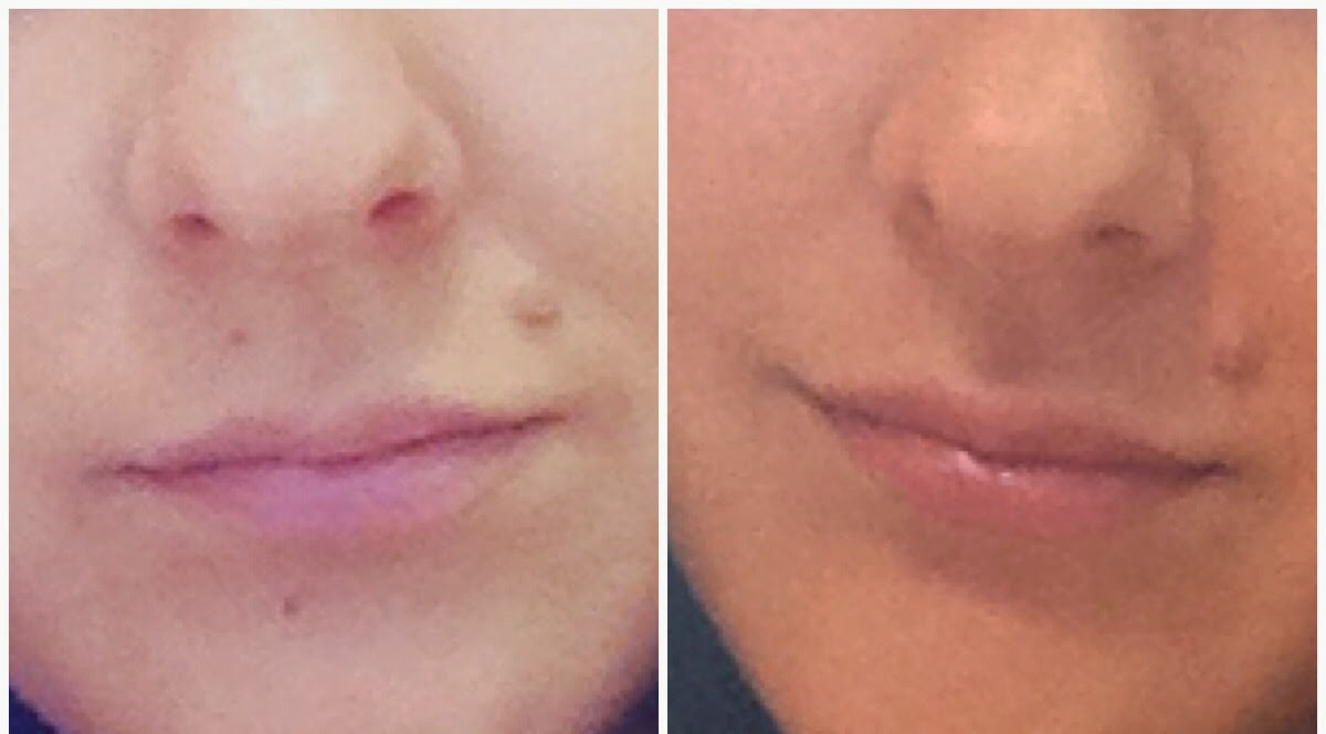 Six Simple Ways You Possibly Can Turn Mole Removal Into Success