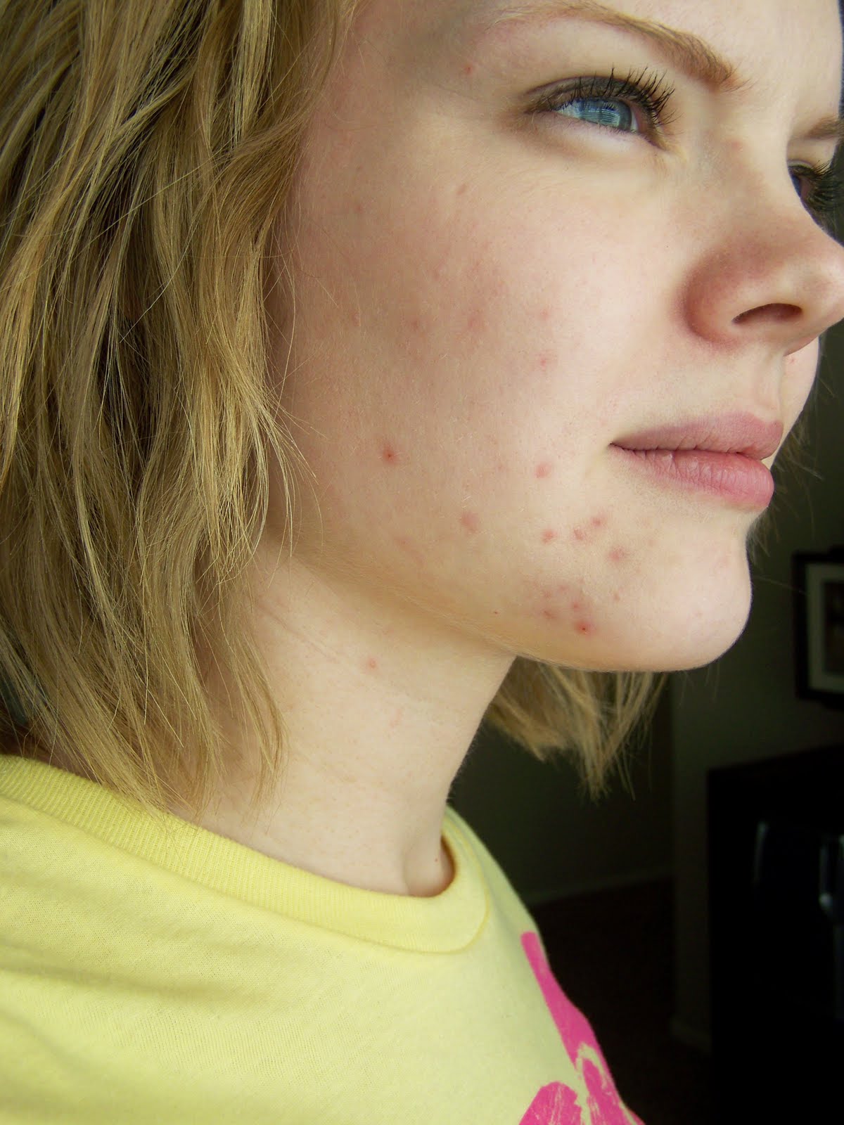 The Terrible Awful ZitFace Dilemma BabyCenter