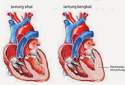 obat herbal jantung bengkak obat herbal jantung bengkak