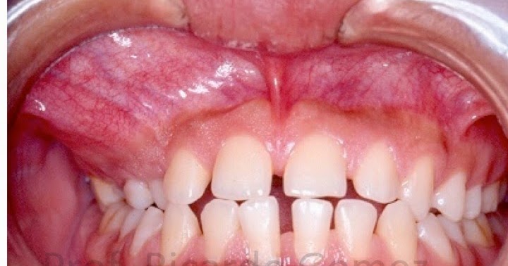 Estomatologia Online Tumor Odontogênico Adenomatoide