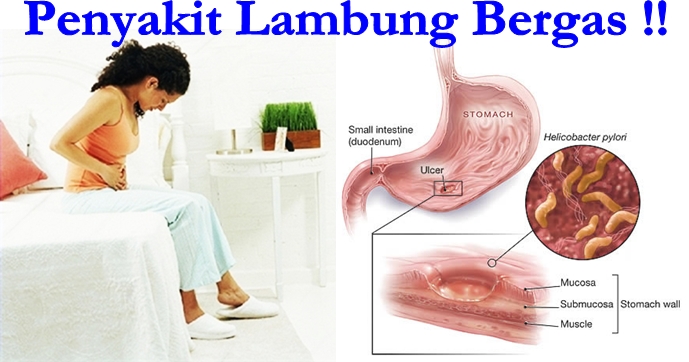 Obat Tradisional Lambung Bergas