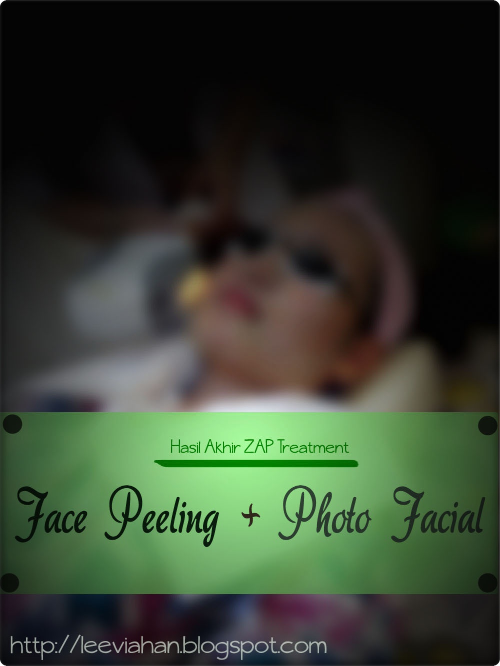 Beauty Blogger Indonesia by Lee Via Han Hasil akhir ZAP Treatment Face