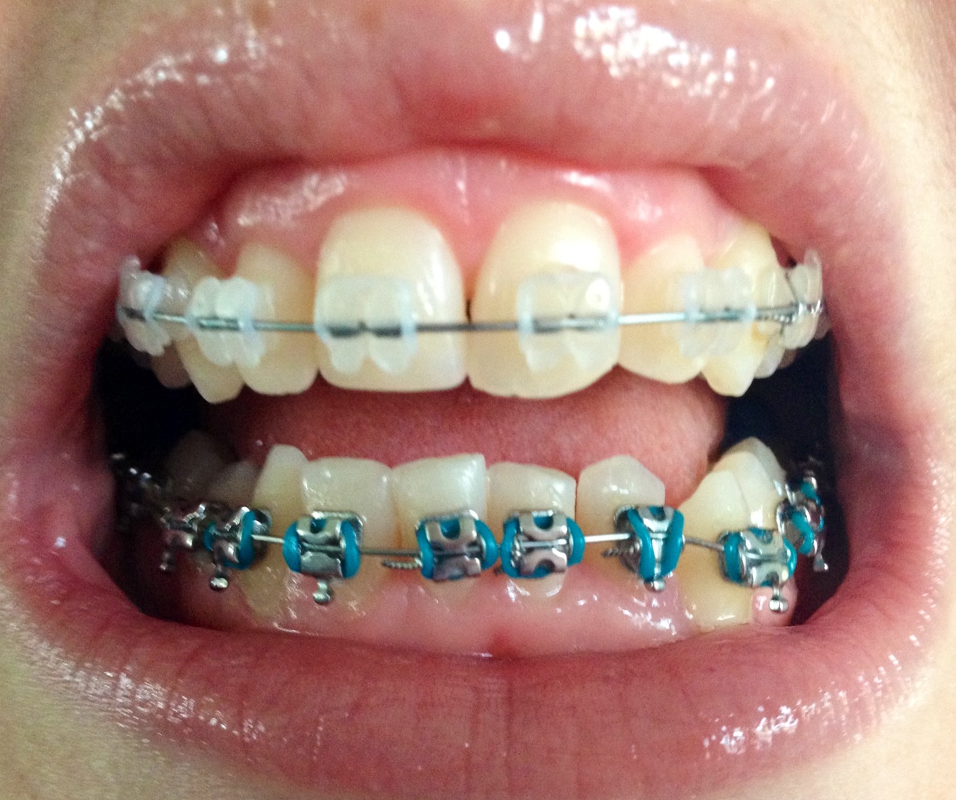 Braces Chick May 2013