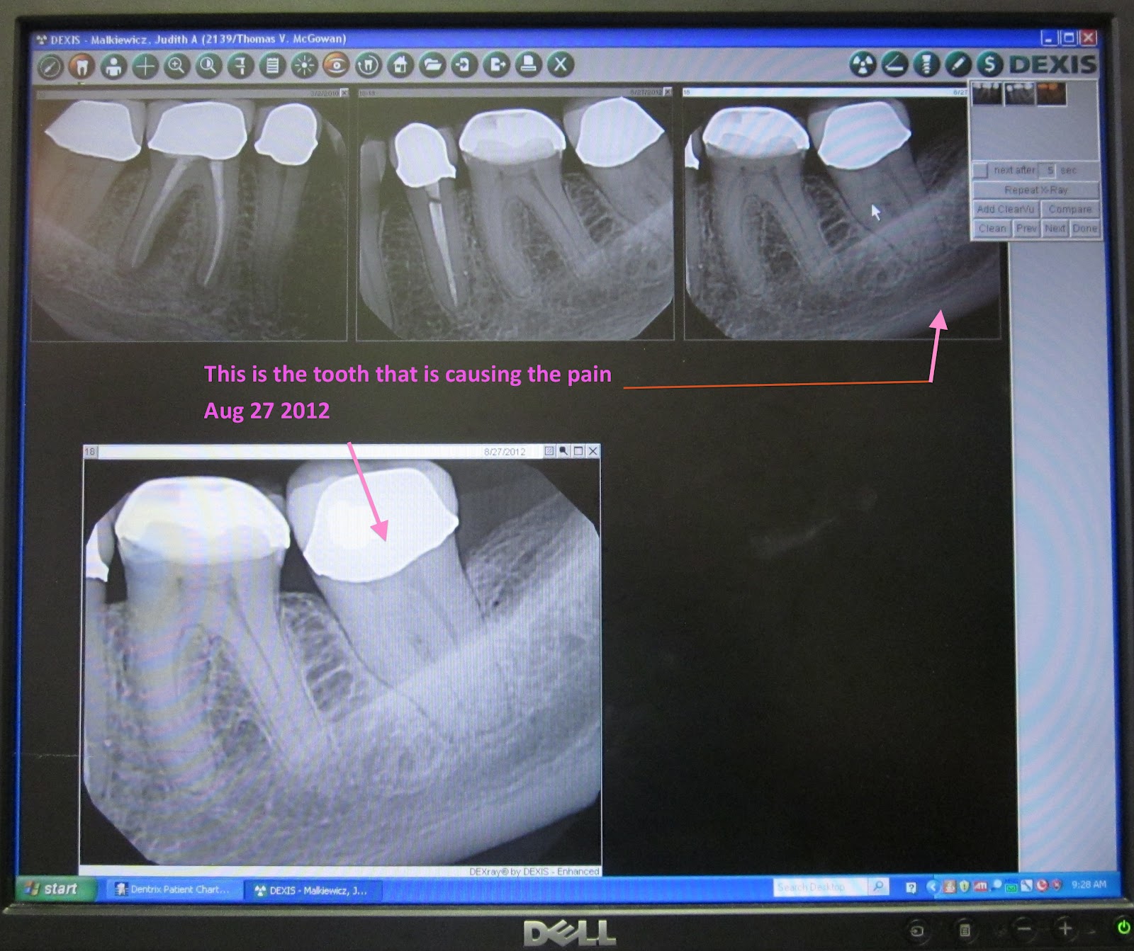 jm's Adventure with Multiple Myeloma 2nd ASCT Day 101 August 27 2012