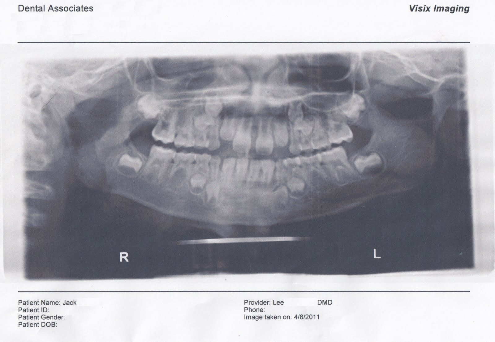 Dental Xrays In Toddlers Find Local Dentist Near Your Area