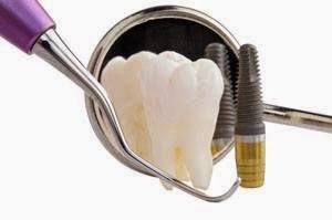 mini implants dentaires