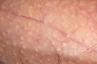 fordyce spots