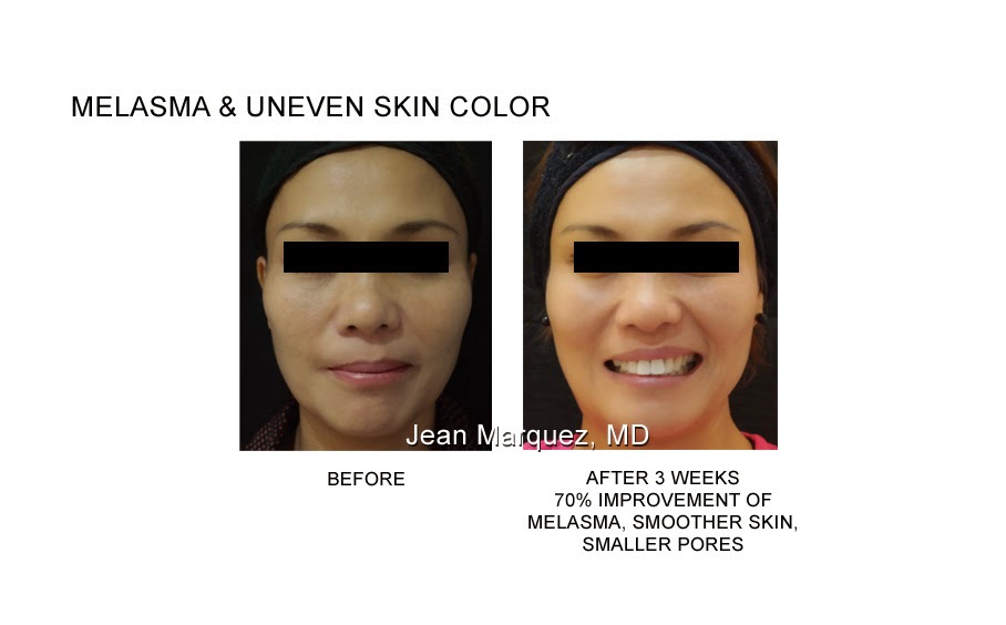 Feature The Skin Specialist's Erase Laser Dear Kitty Kittie Kath