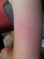 painful insect bite raised welt