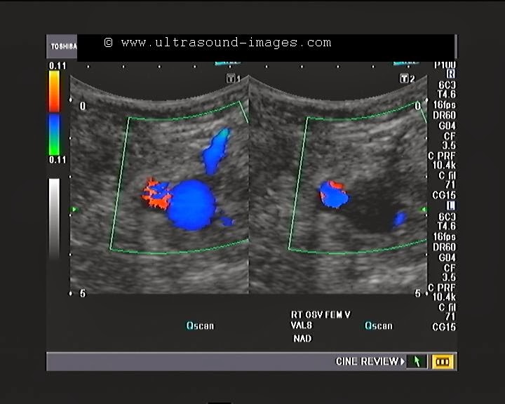 venous doppler venous doppler