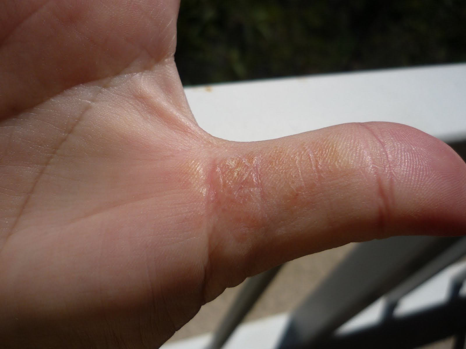 SAN DIEGO LYMER Weird Rash on my Hands
