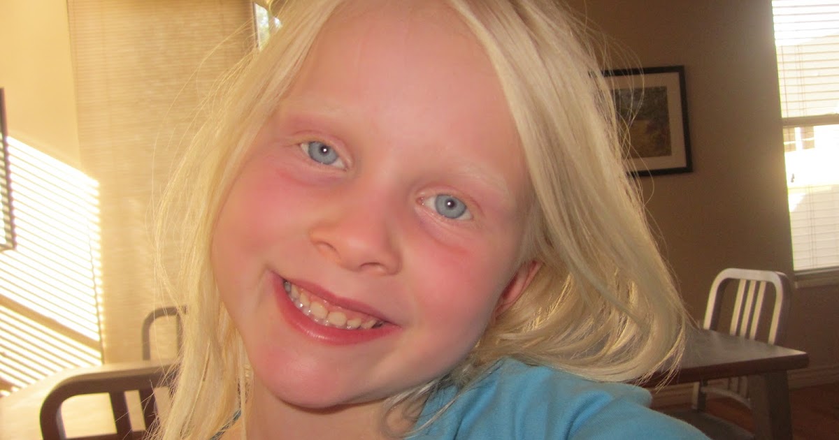 Toothsome Family: Albino or Not?