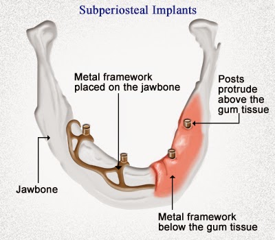 types d'implants dentaires 3