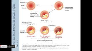 class iii angina class iii angina