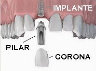 partes de un implante dental cipolletti