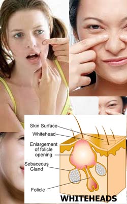 beauty tips how to remove and prevent whiteheads how do whiteheads form