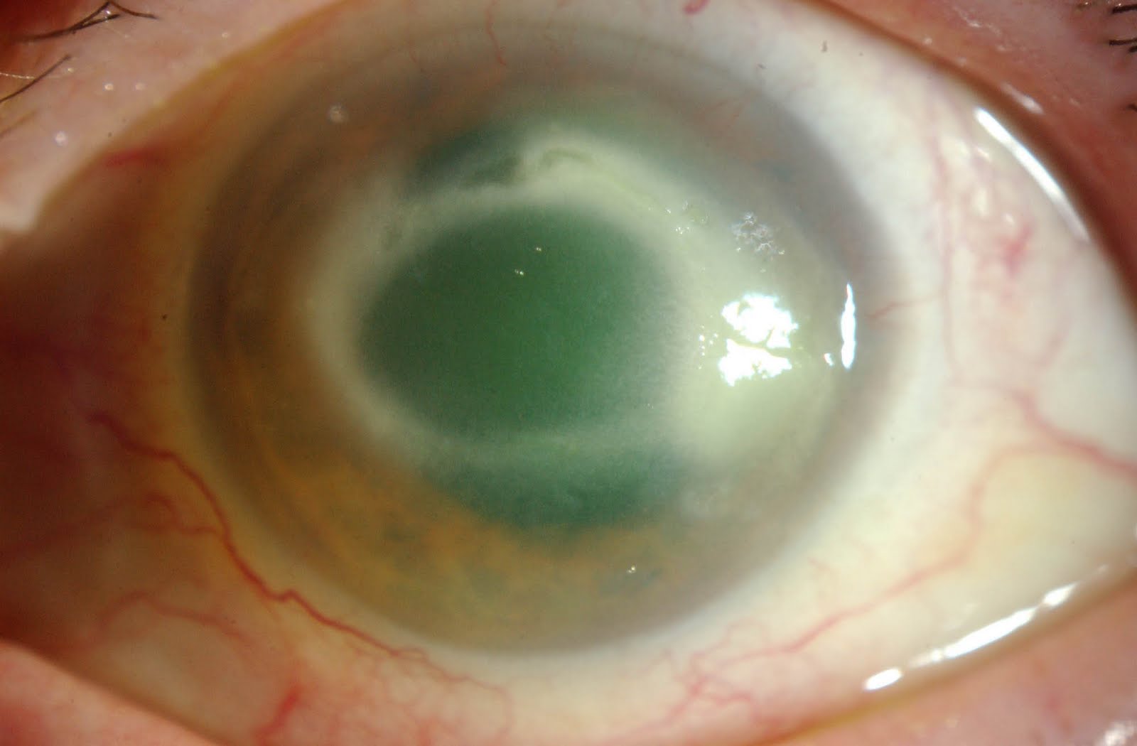 corneal ulcer examination signs causitive agents diagnosis corneal ulcer