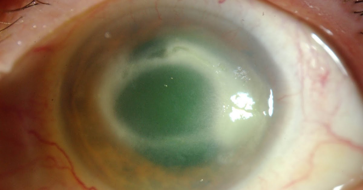 Corneal ulcer review of optometry picture