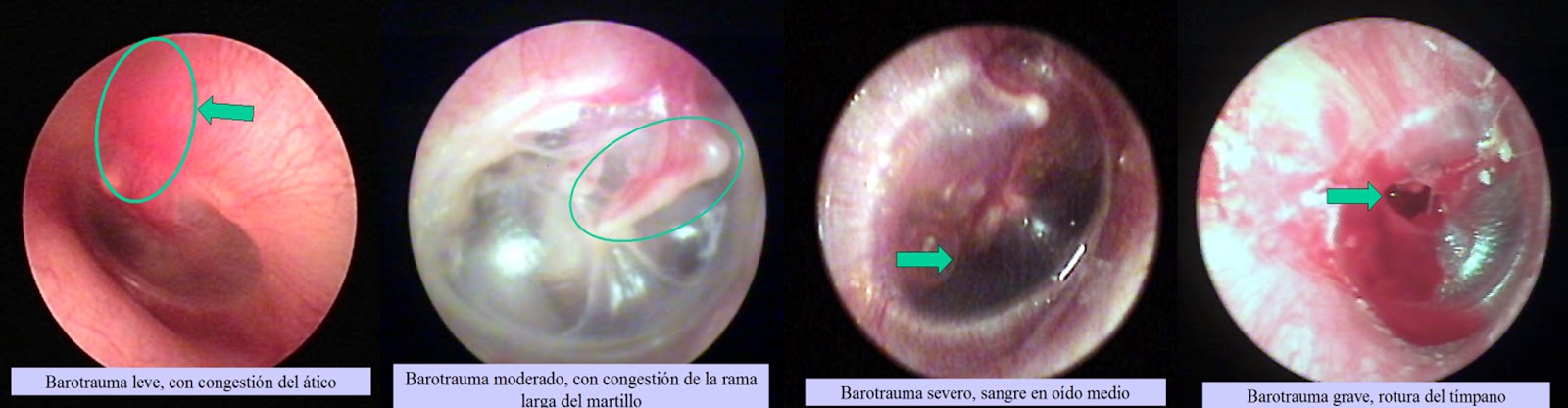ear barotrauma surgery ear barotrauma surgery