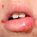 Home Remedies for Fever Blisters | How to Get Rid of Fever Blisters