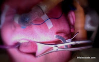 Nasal intubation in general anesthesia for dental treatment Nasal intubation general anesthesia dental treatment