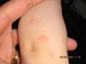 how to get rid of scars from eczema beauty and health moments